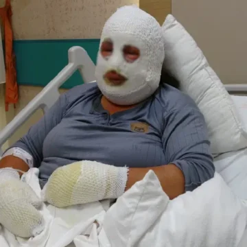 Ardahan'da sobadan çıkan yangında anne ve 6 yaşındaki kızı yaralandı. Ardahan'da ağılda çıkan yangının ardından aile ve çevresindeki yayla evi