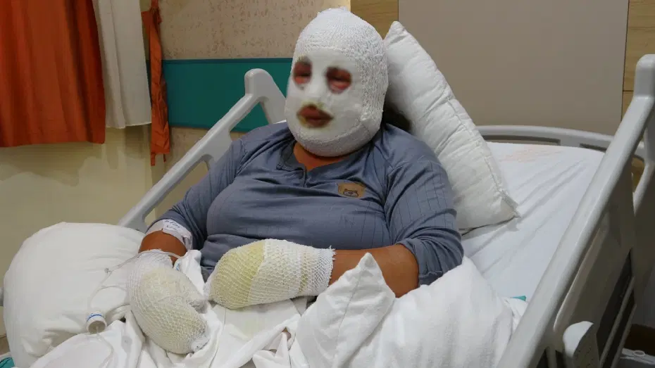 Ardahan'da sobadan çıkan yangında anne ve 6 yaşındaki kızı yaralandı. Ardahan'da ağılda çıkan yangının ardından aile ve çevresindeki yayla evi